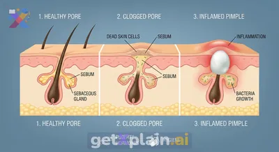 Why Do Pimples Appear on Our Faces?